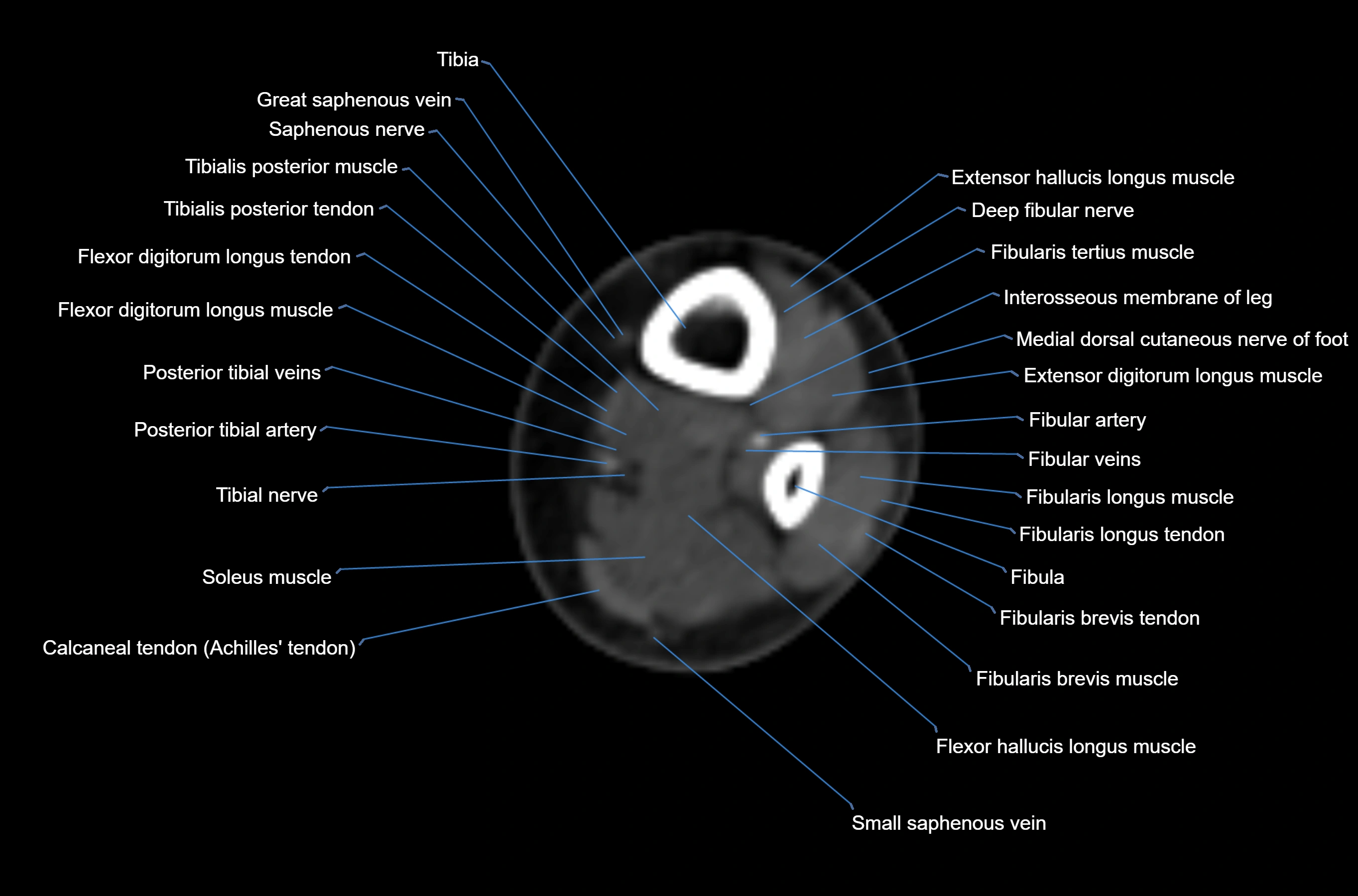CT Ankle axial cross sectional anatomy labelled image -00002.webp
